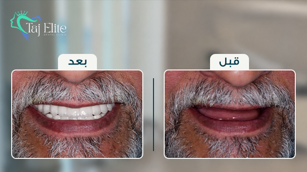 before-^-after4